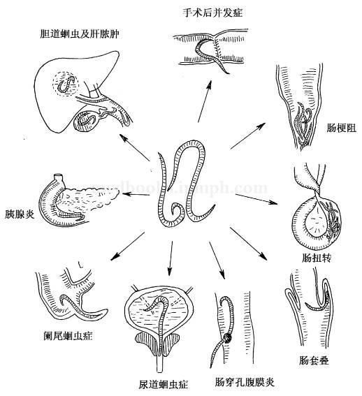 兒童非常容易感染蛔蟲(chóng)病，后果很嚴(yán)重！寶貝爸媽要警惕！