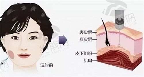 瘦臉-針和溶脂-針的原理及風(fēng)險
