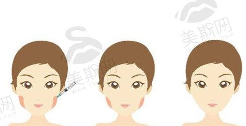 溶脂-針和瘦臉-針成分、原理都不同