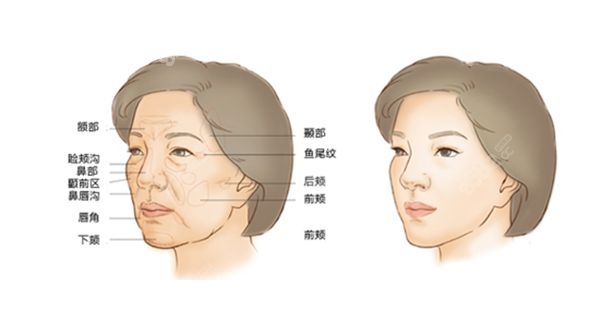 自體脂肪填充太陽(yáng)穴凹陷疼嗎？是局麻還是全麻多久消腫