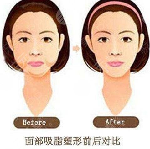 面部吸脂原理和注意事項