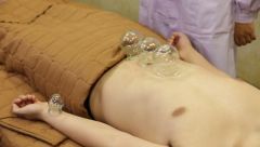 拔罐療法—腹痛的治療