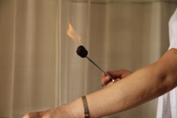 拔罐減肥療法先天不足后天失養(yǎng)者皆可用