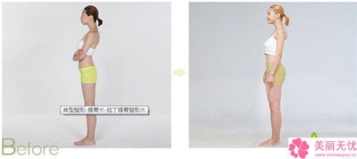宿州市臀部減脂術(shù)價格(費用)清單2024熱門新篇巨獻-宿州市臀部減脂術(shù)大概要費用多少