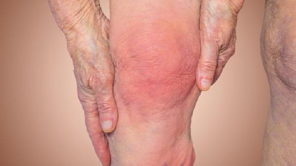 饮食型肥胖、水肿型肥胖 对号入座来掌握减肥重点