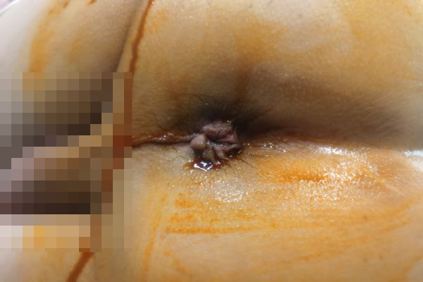 混合痔圖片