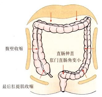 排便節(jié)制。