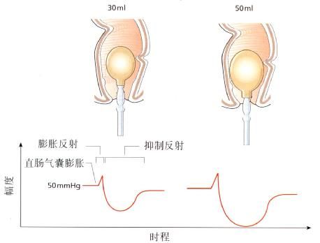 直腸肛門抑制反射
