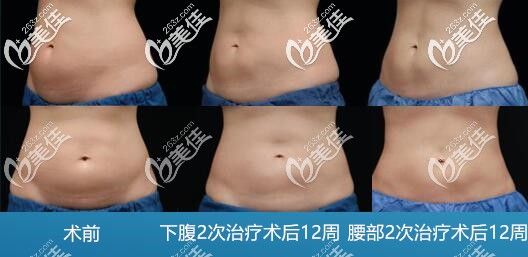 腰腹部減脂
