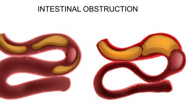 肠梗阻灌肠方法