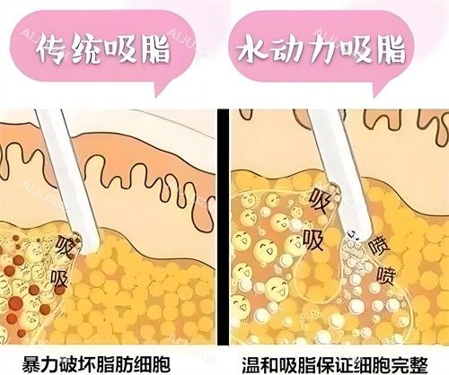 負(fù)壓吸脂和水動(dòng)力吸脂方式對比動(dòng)畫圖