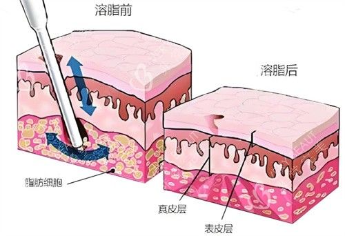 射頻溶脂術(shù)皮膚層