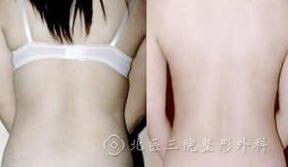 背部吸脂