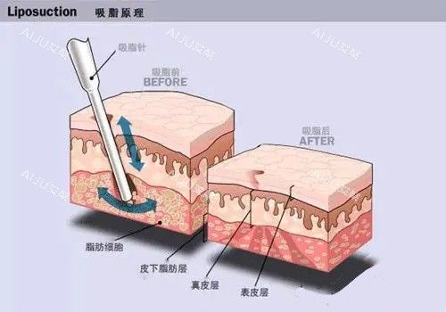 水動力吸脂手術(shù)原理動畫圖
