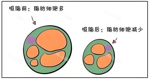 吸脂前后脂肪細胞對比動畫圖