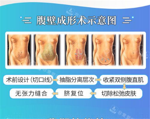 腹壁成形術(shù)示意圖
