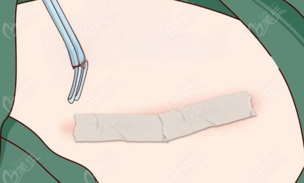 北京腹壁成型术多少钱？