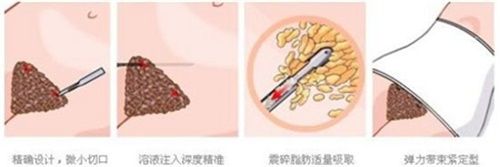 腹部吸脂示意圖