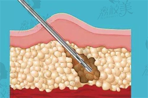 腰腹吸脂貴不貴