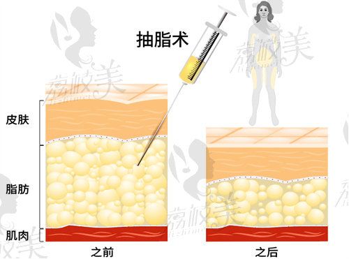 腰腹吸脂好不好