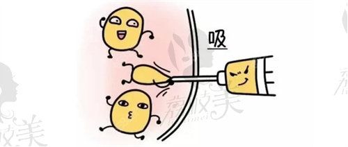 廣州腰腹吸脂怎么樣
