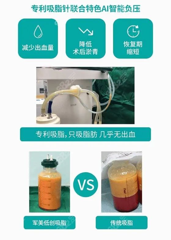 智能A全身I吸脂技術(shù)比傳統(tǒng)吸脂出血量更少.jpg