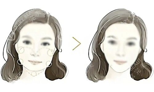 面部吸脂對比