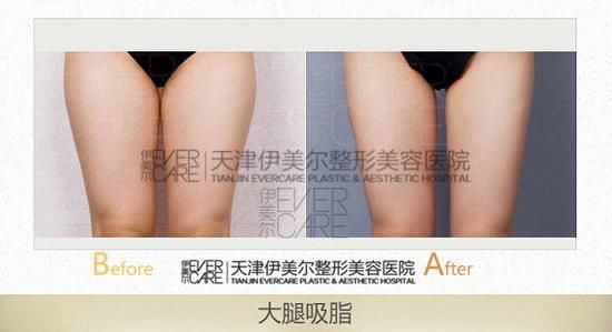 天津伊美爾吸脂