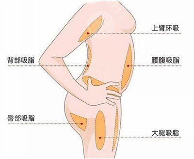 360度吸脂減肥價格多少錢
