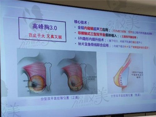 广州美莱胸部整形技术好