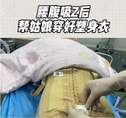 腰腹吸脂術(shù)后穿塑身衣圖片