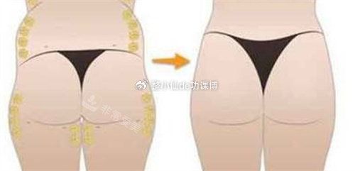 臀部吸脂