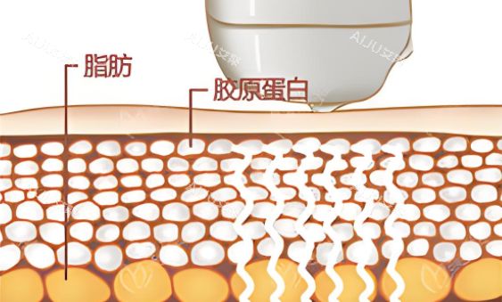 激光溶脂图