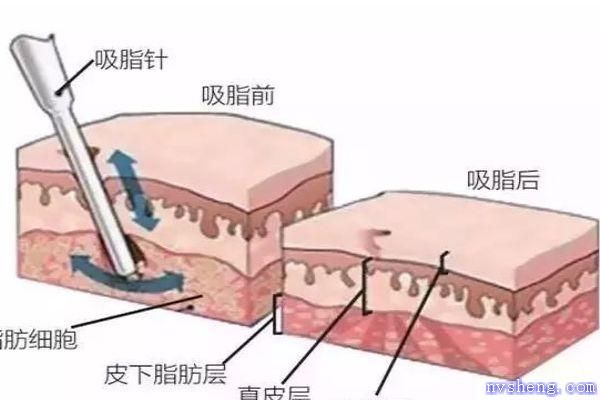 水動力吸脂的工作原理是什么呢 水動力吸脂多少錢一次呢