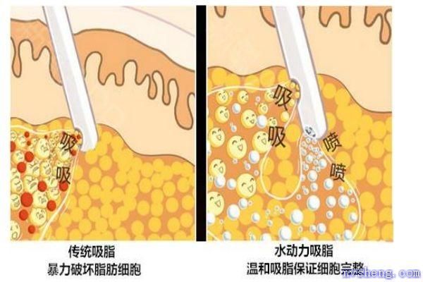什么是水動力吸脂呢 水動力吸脂有什么用呢