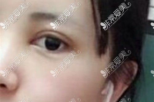 歐洲之星Fotona4d激光去眼袋手術(shù)后