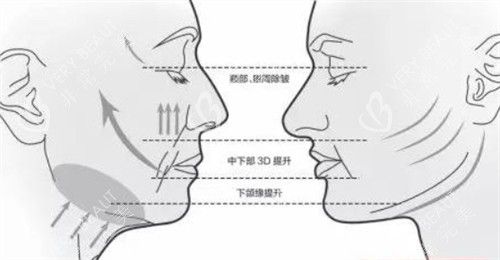 面部提升前后各個(gè)部位的對(duì)比