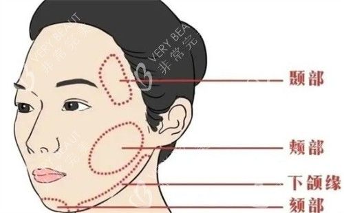 面部提升可以提升的區(qū)域