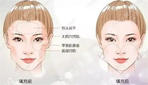 面頰填充術前后對比