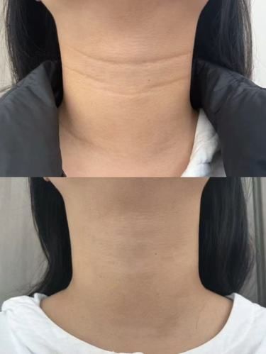嗨体去颈纹丨颈部抗衰救星