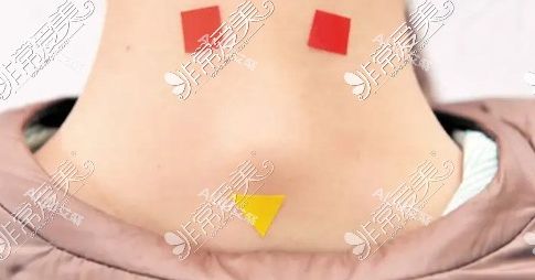 富貴包術(shù)后傷口處理