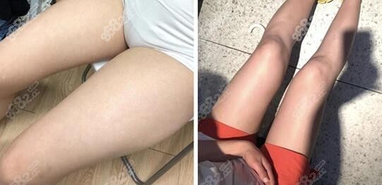 大腿吸脂前后對(duì)比照