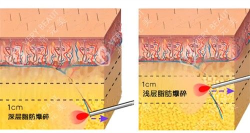 激光溶脂作用皮膚層圖