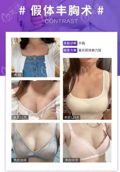 北京米蘭柏羽麗都假體隆胸范例
