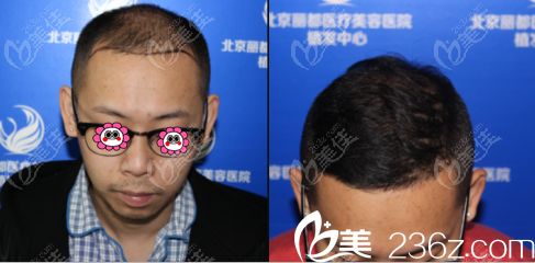 北京米蘭柏羽麗都馬建民頭發(fā)種植例子