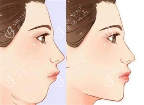 雙下巴抽脂前后對比側(cè)面動畫圖