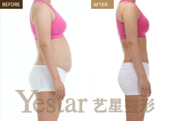 螺旋立體吸脂 輕松塑美