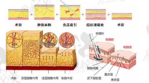 鄭大二附屬醫(yī)院李會(huì)勇吸脂手術(shù)預(yù)約方式