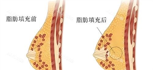 自體脂肪隆胸脂肪對比