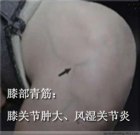 [轉(zhuǎn)載]青筋診法全集